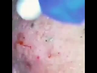 best pimple big byfcglcge0t mp4 best