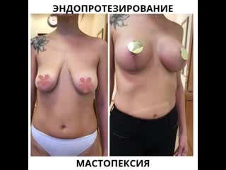 best эндопротезирование молочных желез и мастопексия best