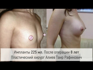 best увеличение груди через 18 лет результат операции хирург алиев таир рафикович best