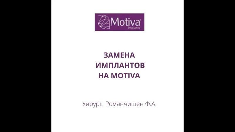 best замена имплантов через 18 лет после устанои best