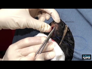 best dr sandra lee aka dr pimple popper inside out kahlua pilar cyst best