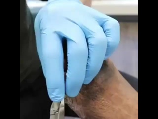 best pimple big bygpzzggheg mp4 best