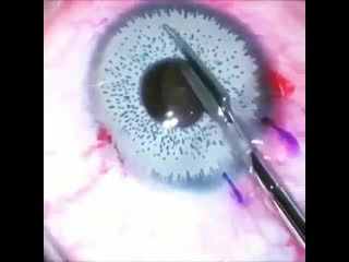 best iris colour implant due to chronic uveitis glaucoma and cataract formation best