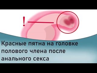 best красные пятна на половом члене после анального секса best