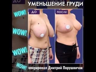 best уменьшение груди при гигантомастии оперировал дмитрий порушничак mp4 best
