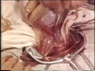 best овариоэктомия удаление яичников при раке молочной железы oophorectomy removal of the ovaries best