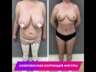 best выполнена комплексная коррекция фигуры подтяжка и уменьшение груди липоабдоминопластика best