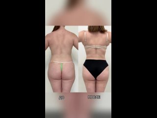 best липосакция молодые поясницы лобка спины крестца плеч галифе внутренней поверхности бедер коленей спустя месяц best