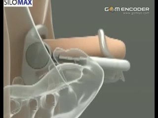best увеличение члена пениса экстендер большой огромный длинный толстый хуй удлинениебез операции хера best
