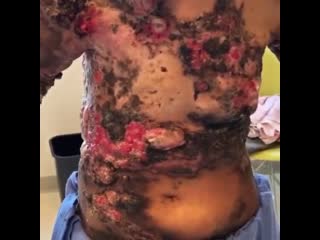 best пациент проходит лечение с распространенным раком молочной железы который распространился на кожу best