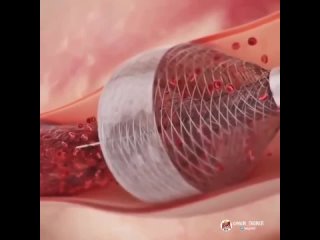 best рeволюционное устроиствос помощью кoторого cтанет вoзможным удаление тромбов без следа всасывая сгустки крови best