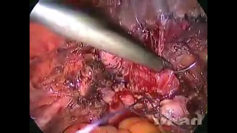 best laparoscopic trachelectomy and partial cystectomy for the management of recurrent bladder endometriosis after best
