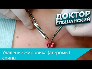 best удаление жировика атеромы спины best