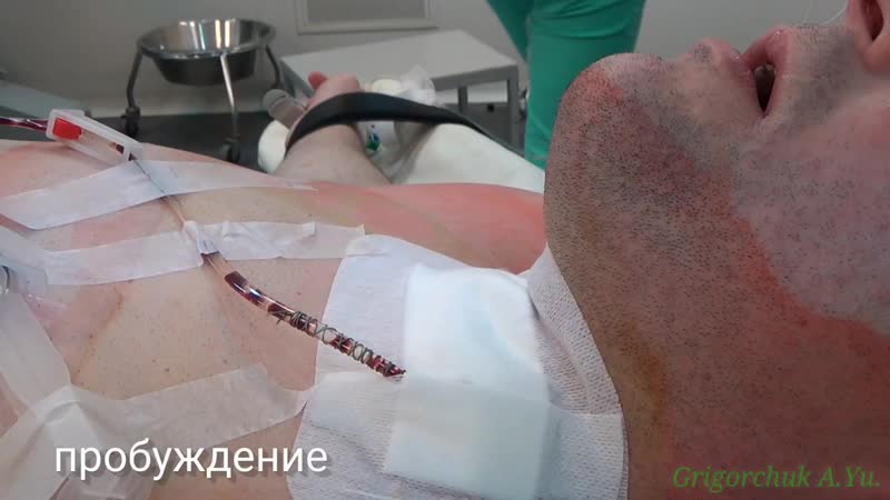 best внутри операционной live surgery циркулярная резекция трахеи стеноз best