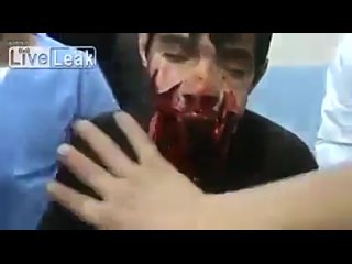 best молодому парню снарядом оторвало челюсть страшное видео best